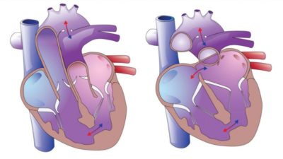 Что такое дегенеративный порок сердца